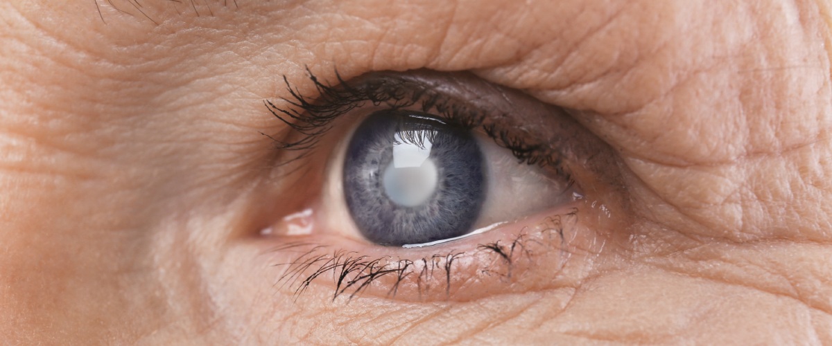 Mujer con cataratas en los ojos